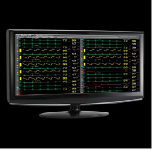 Remote ICU Monitoring